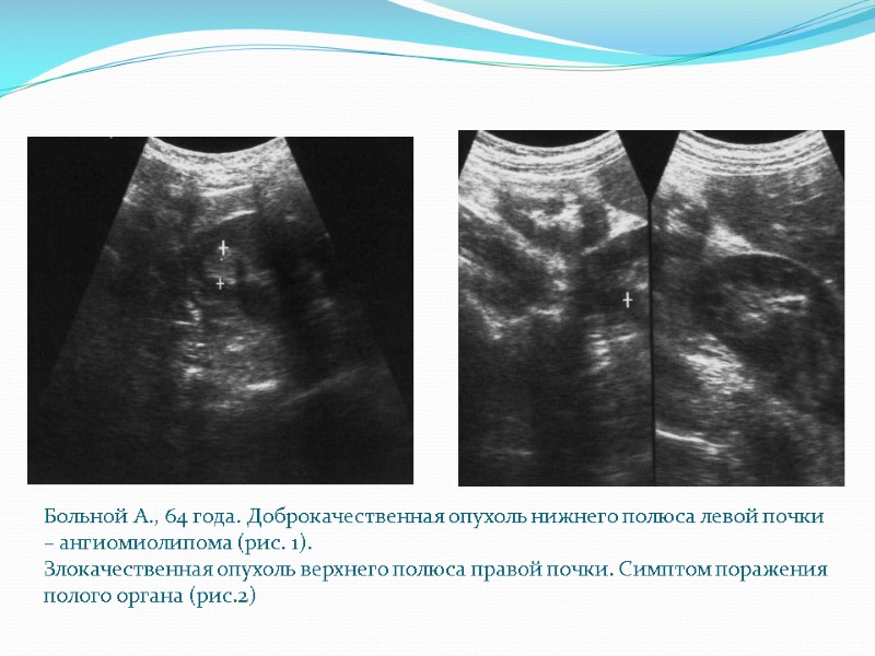 Больной А., 64 года. Доброкачественная опухоль нижнего полюса левой почки – ангиомиолипома (рис. 1).